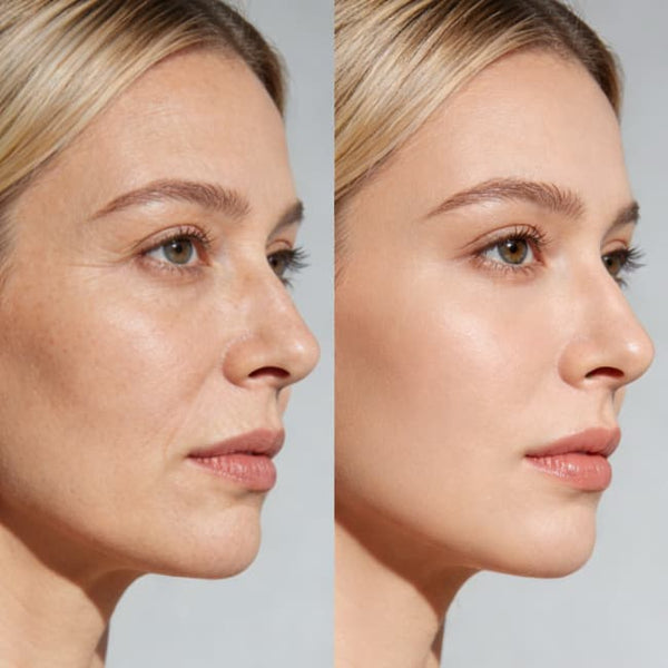 Customer review — SENNEY™ Athena HIFU Ultrasound skin lifting results